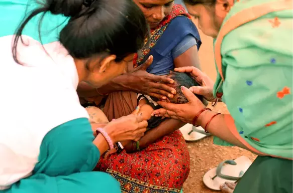 Indias Measles Crisis: Insights from Johns Hopkins Research