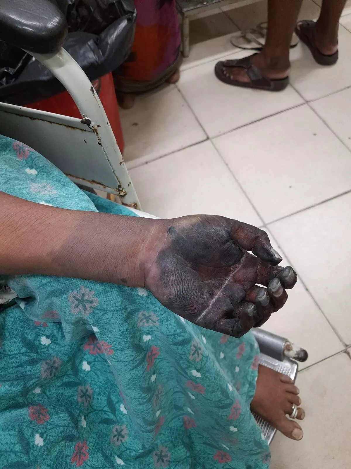 Fake Doctor’s Treatment Endangers Woman’s Hand in Warangal