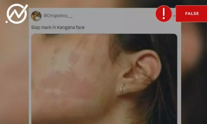 Fact Check: Photo From Anti-Mosquito Spray Ad Campaign Falsely Linked To Kangana Ranaut Slap Row