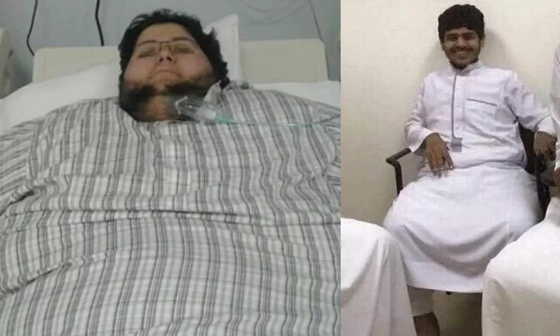 Huge Transformation: Worlds Heaviest Man Khalid Shaaris Journey From 610kg to 63kg