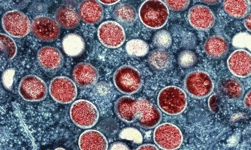 Sweden Reports First Case of Contagious mpox Strain Outside Africa