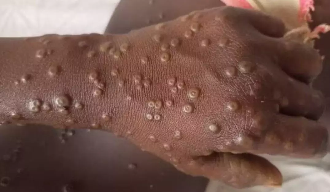 Kerala Health Department Issues Mpox Alert Amid Global Reports of Viral Infection