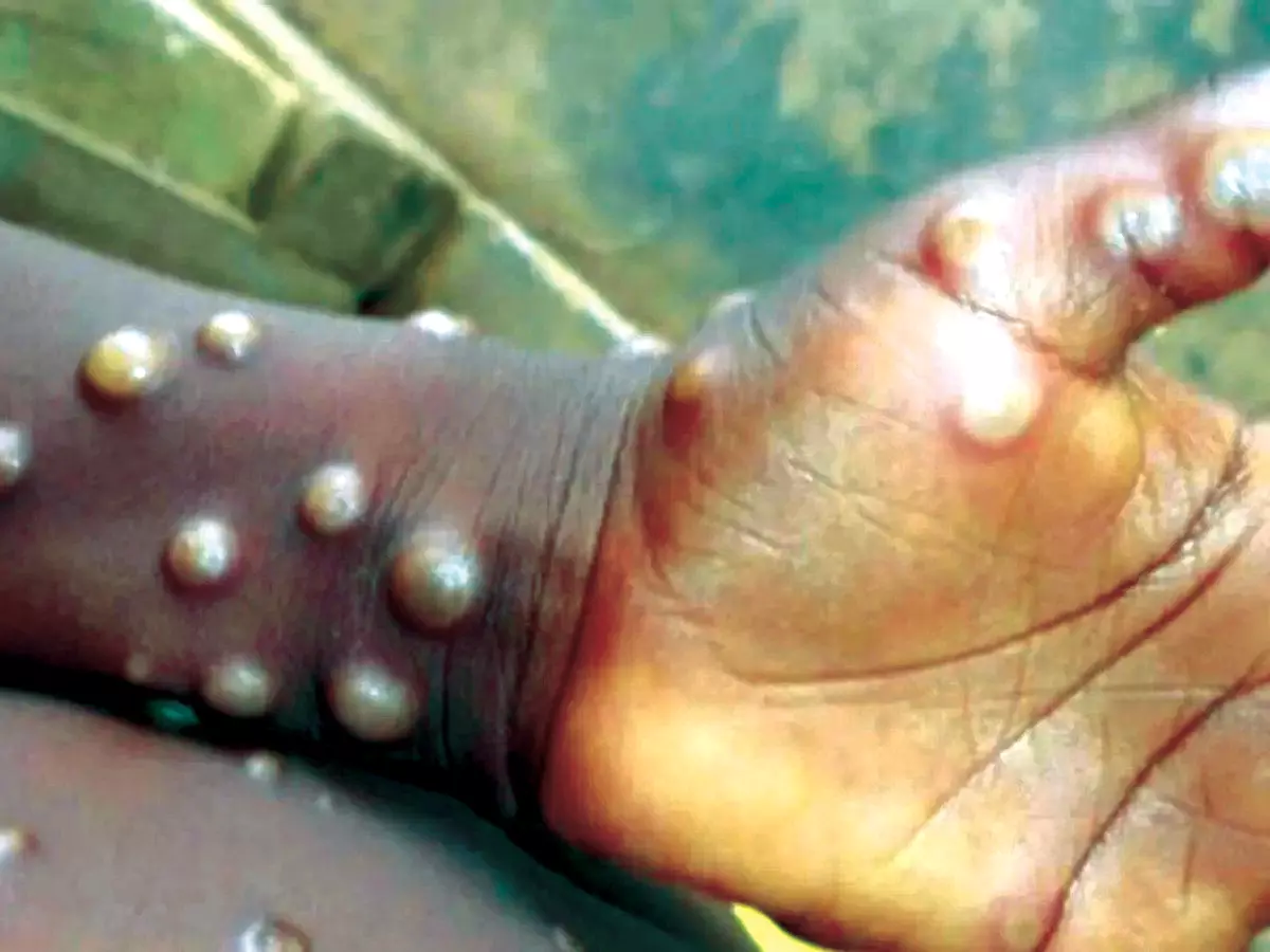 What is Mpox, Now Declared Global Health Emergency