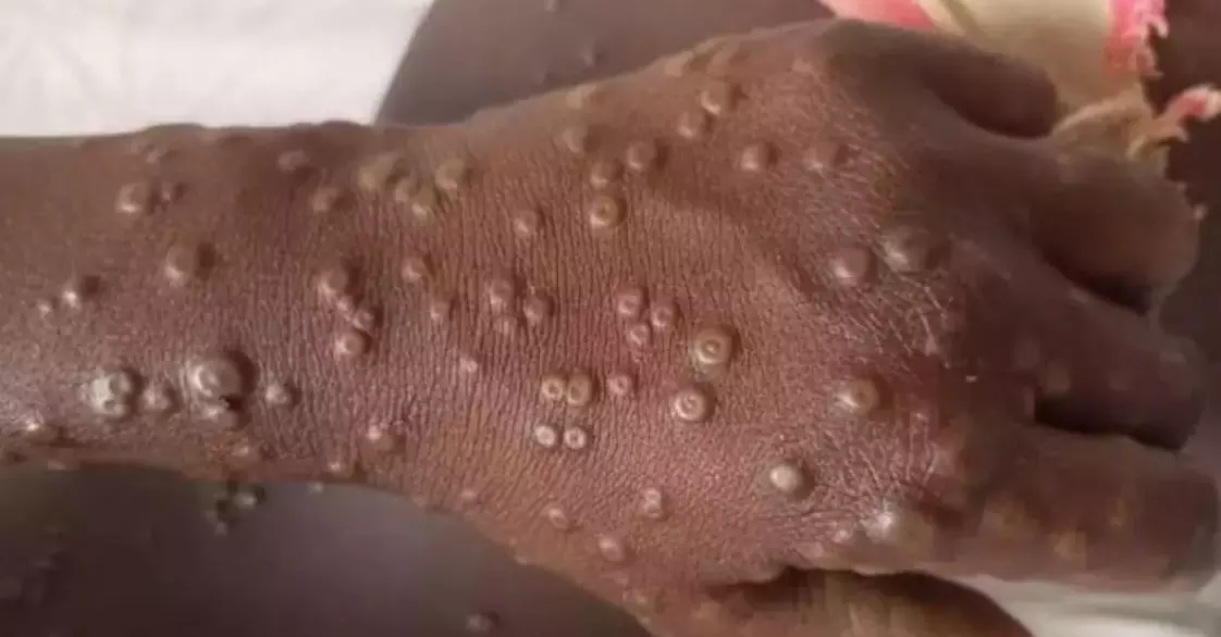 AP Geared to Deal With Mpox; Health Staff Keeping Close Watch on It