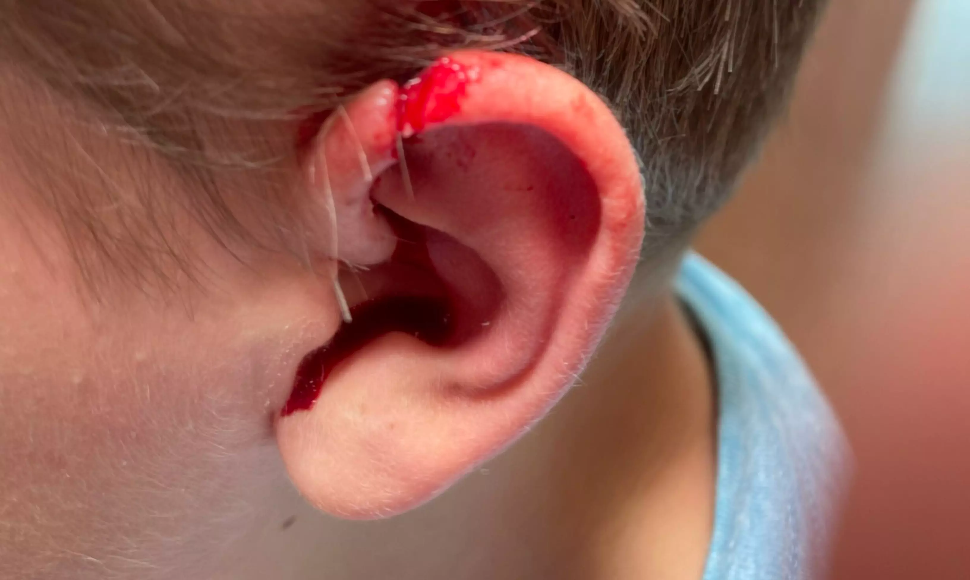 Hyderabad: School Staff Accidentally Cuts Child’s Ear