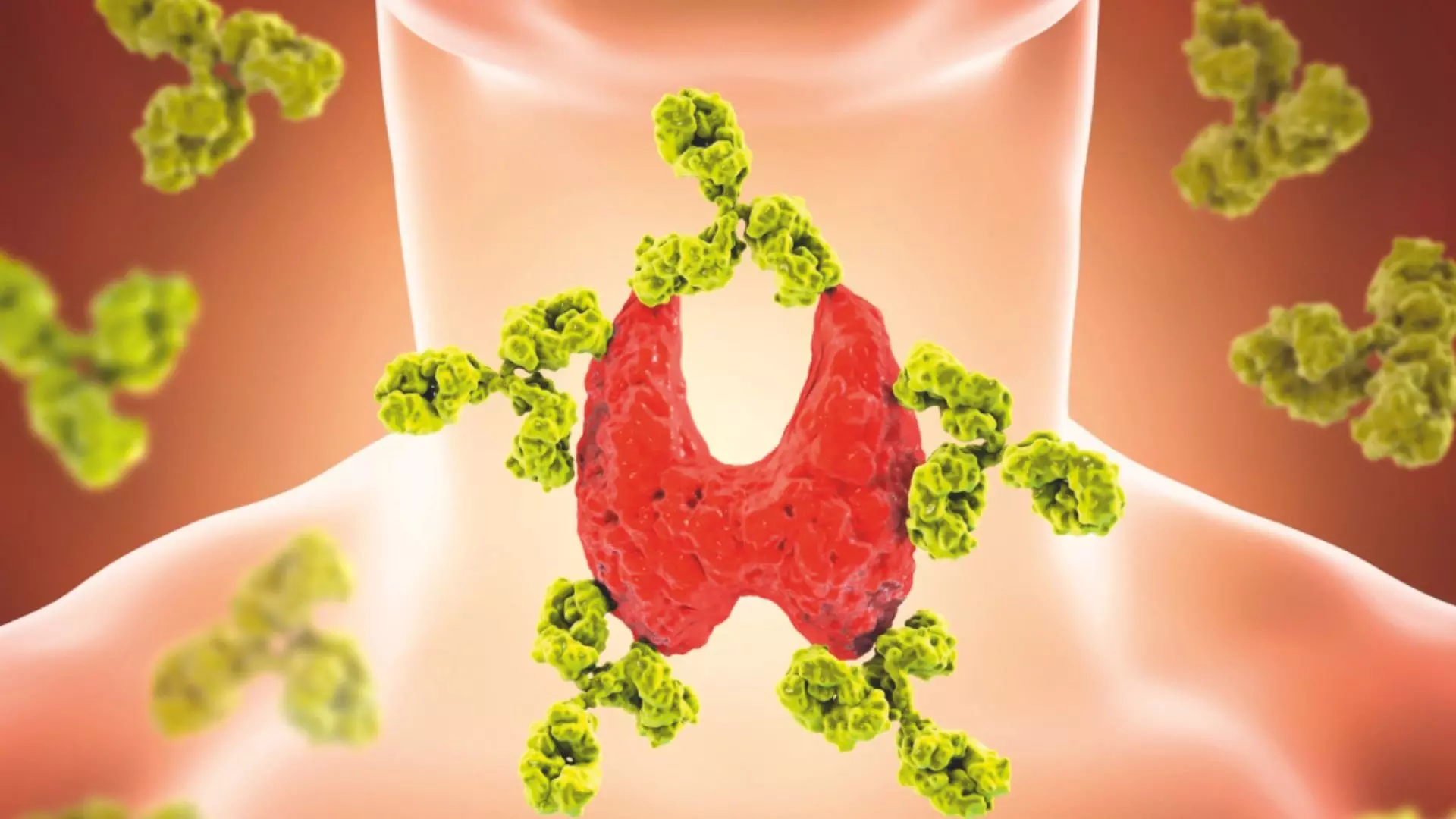 Hashimoto’s: The Thyroid Gland Health Scare