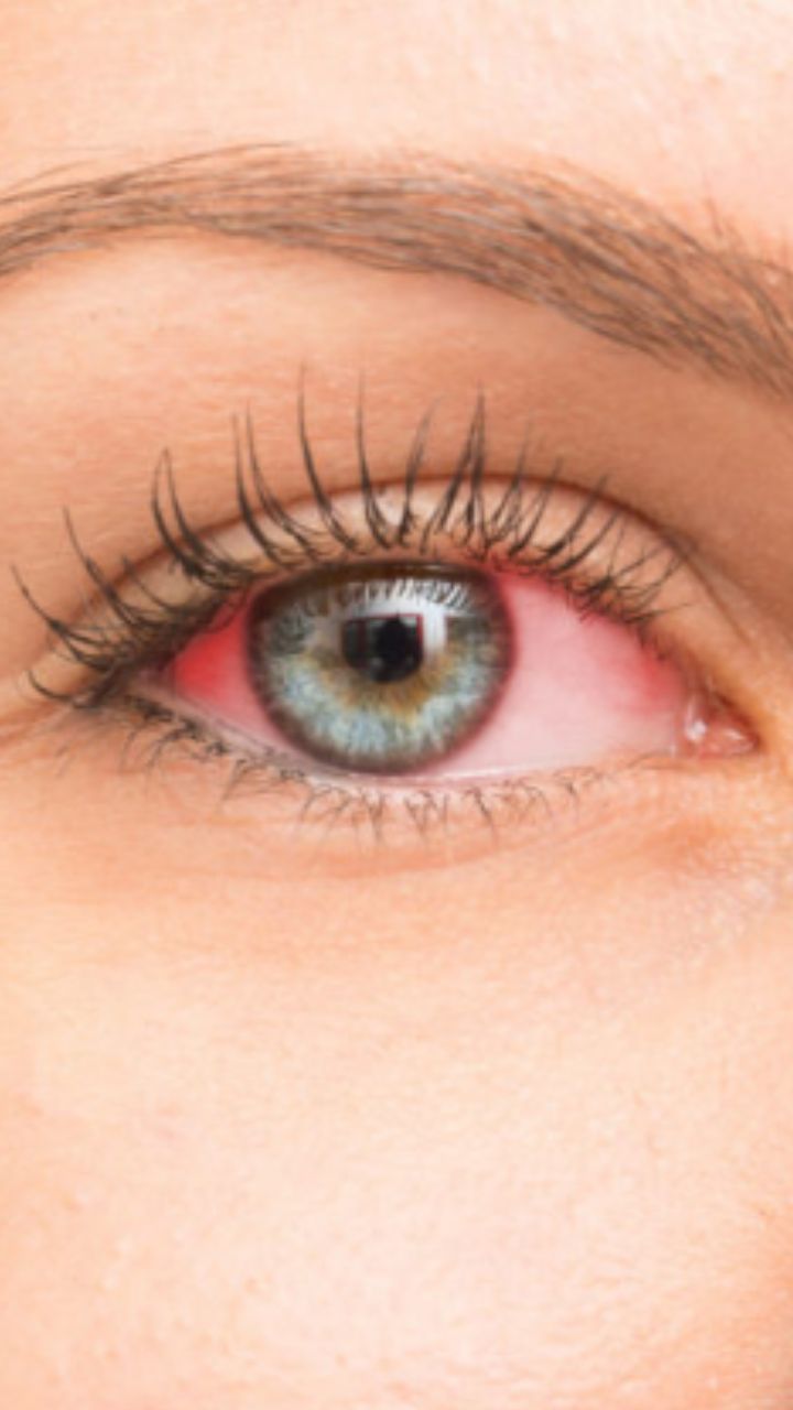 How to Prevent and Treat Eye Infections