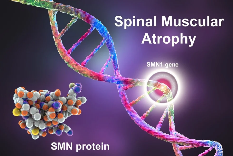 Need for awareness to tackle symptoms of Spinal Muscular Atrophy