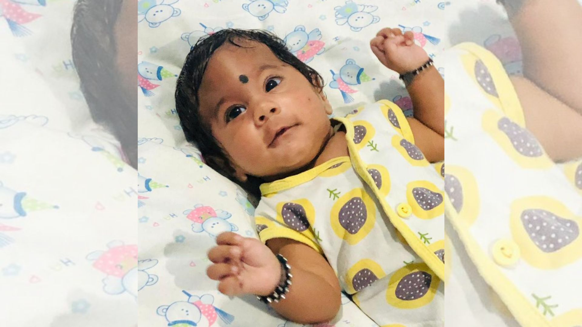 Rare Surgery for Baby with Fused Skull